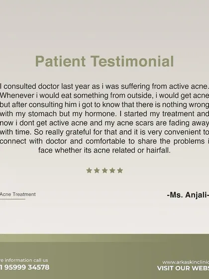 This patient testimonial from Ms. Anjali highlights her journey with us. She was suffering from active acne due to hormonal issues, and after treatment, her acne is gone and the scars are fading.
