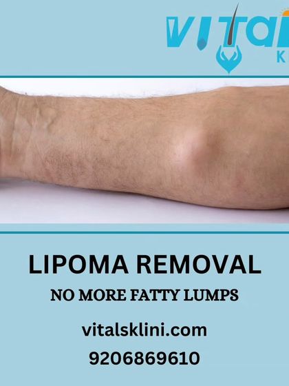 Vitals Klinic - Dermatosurgery (Minor Procedures) Mole, Skin Tag & Growth Removal photo 5