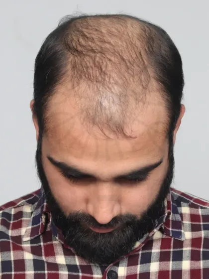 This is a 16-month result for a Grade 5A case, achieved with 5000 grafts. A true comeback story.