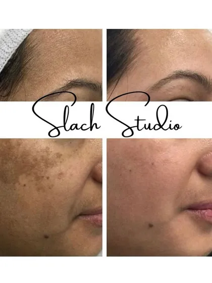 This result showcases the power of the Korean Glass Skin treatment on stubborn pigmentation and uneven skin tone. Notice the significant lightening of dark patches on the cheeks and forehead, revealing a much brighter and more uniform complexion.