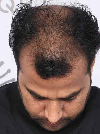 An incredible 5-month result for a diffuse grade 6 case. We used 4500 grafts to cover the frontal hairline, mid-scalp, and crown.