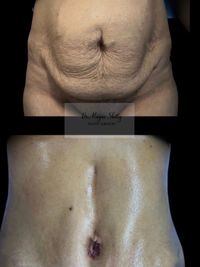 Body Contouring Surgery