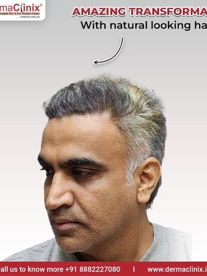 This is an amazing transformation with a natural looking hairline. We are sharing this result again to offer hope to those with advanced grade baldness, showing what is possible with expert care.