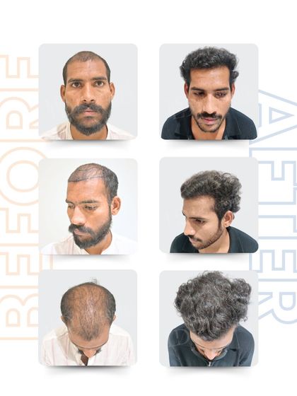 Nikhil Jankar was facing noticeable hair thinning. With 2,800 grafts using the advanced RT-FUE technique, I restored his hairline to look fuller and more natural. Today, he carries his new confidence with pride.