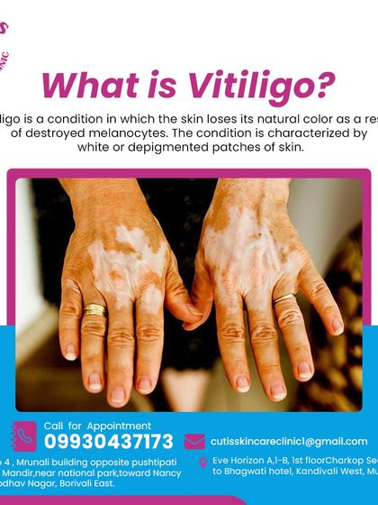 This graphic explains what vitiligo is: a condition where the skin loses its natural color due to destroyed melanocytes, resulting in white patches. We offer professional treatments to manage vitiligo and help you regain confidence in your skin.