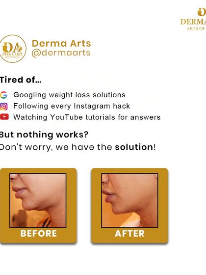 A before-and-after of our non-surgical face lifting treatment. This image shows the significant improvement in jawline definition and reduction of double chin fat.