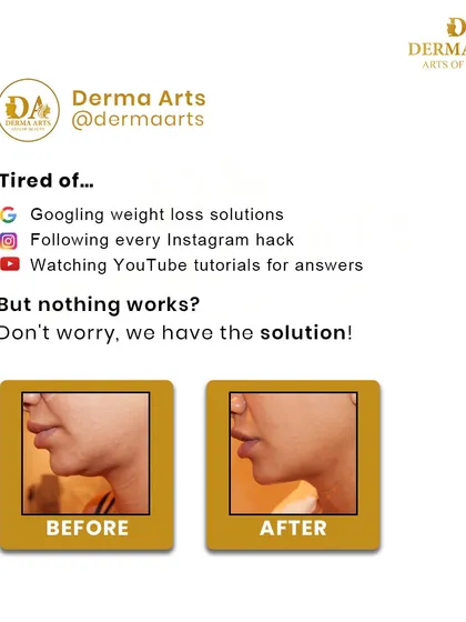 A before-and-after of our non-surgical face lifting treatment. This image shows the significant improvement in jawline definition and reduction of double chin fat.