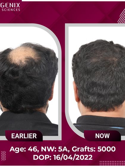 A remarkable 5000-graft transformation for a 46-year-old patient with Grade 5A baldness.