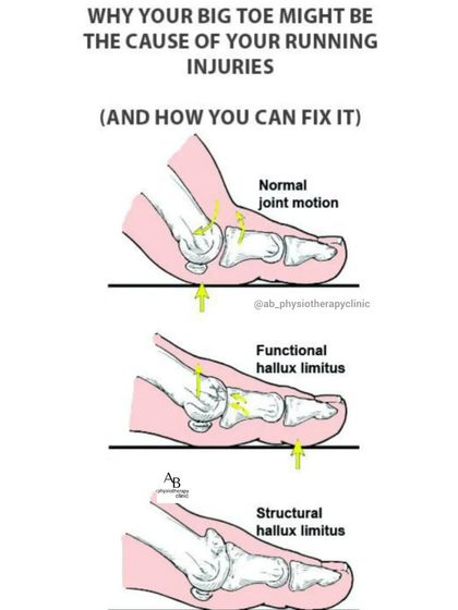 A stiff big toe, or hallux limitus, can be the hidden cause of running injuries in your ankle, knee, or even hip. This diagram explains how limited joint motion forces your body to compensate, leading to pain elsewhere.
