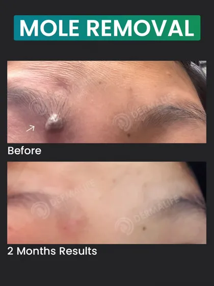 Here you can see the result just two months after a surgical mole removal. My technique focuses on complete removal with precision to ensure the mole does not return and to leave behind the most minimal scar possible. The final result is clear, smooth skin.