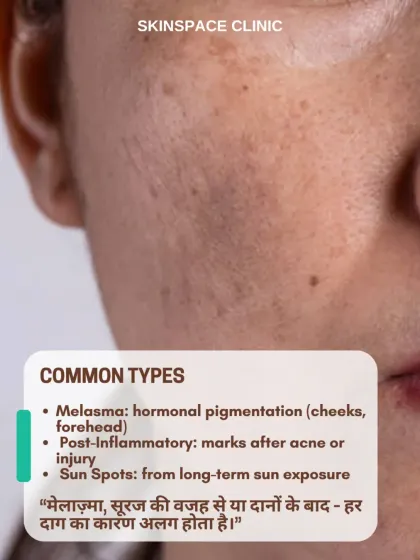 Not all dark spots are the same. This image explains the common types of hyperpigmentation, including hormonal melasma, post-inflammatory marks from acne, and sun spots from long-term sun exposure.