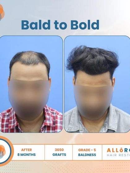 From Bald to Bold. This 8-month result for a Grade 5 case, using 3650 grafts, shows a complete transformation. The close-up of the hairline demonstrates the natural and dense packing of follicles.