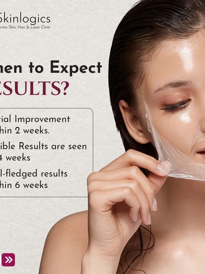 When can you expect results from a Cosmelan Peel? This image provides a timeline, noting initial improvement within 2 weeks and full-fledged results within 6 weeks.