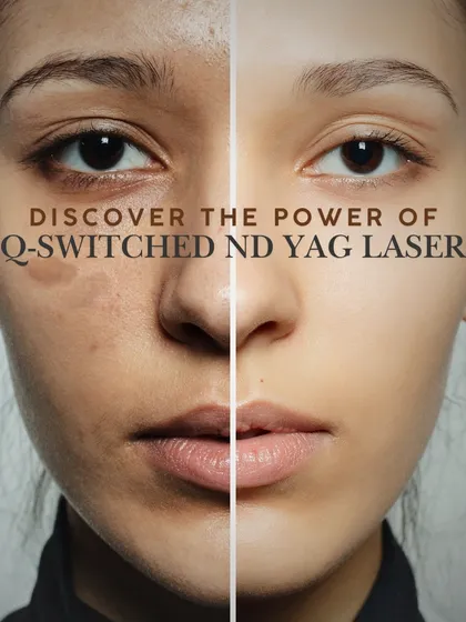 This visual demonstrates the power of the Q-Switched ND YAG laser for pigmentation correction. By targeting melanin at its source, this treatment effectively fades issues like melasma and stubborn dark spots, leading to a clearer and more even-toned complexion.