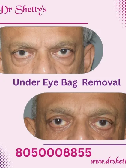 This image shows the result of an under-eye bag removal, also known as lower blepharoplasty. The procedure effectively removes excess fat and skin to create a smoother, more rested, and youthful appearance around the eyes.