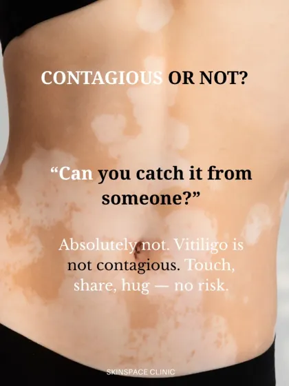 It is a common misconception that vitiligo is contagious. This is absolutely not true. You cannot catch it from someone, and we aim to bust myths surrounding the condition.