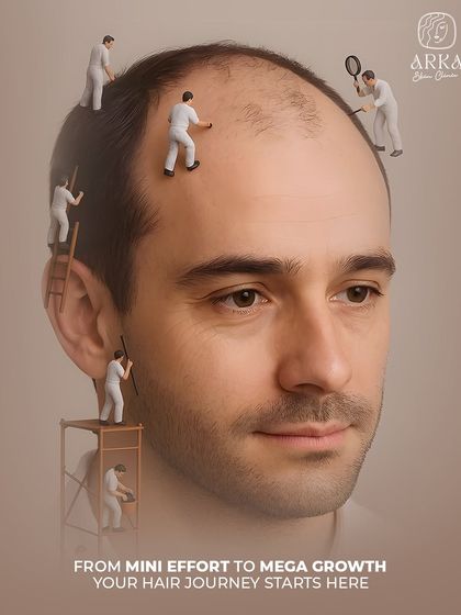 Your hair journey starts here. This creative visual represents the detailed, meticulous work our team puts into every hair transplant procedure, ensuring mega growth from a mini effort on your part.