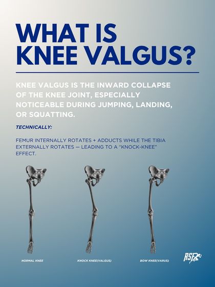What is Knee Valgus? This graphic provides a technical definition of the "knock-knee" effect, showing the difference between a normal knee and one in a valgus position.