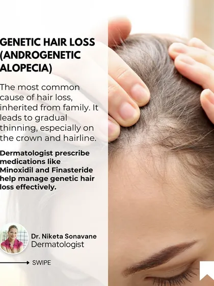 Genetic hair loss, or androgenetic alopecia, is the most common cause of hair thinning, inherited from family. I can prescribe effective medications like Minoxidil and Finasteride to help manage this condition and preserve your hair.