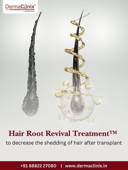 Our Hair Root Revival Treatment is a specialized therapy we use to decrease the shedding of hair after a transplant, helping more grafts to grow immediately and improving the overall result.