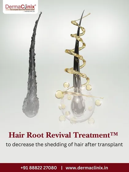 Our proprietary Hair Root Revival Treatment is designed to decrease the shedding of hair that can occur after a transplant, ensuring more grafts survive and thrive.