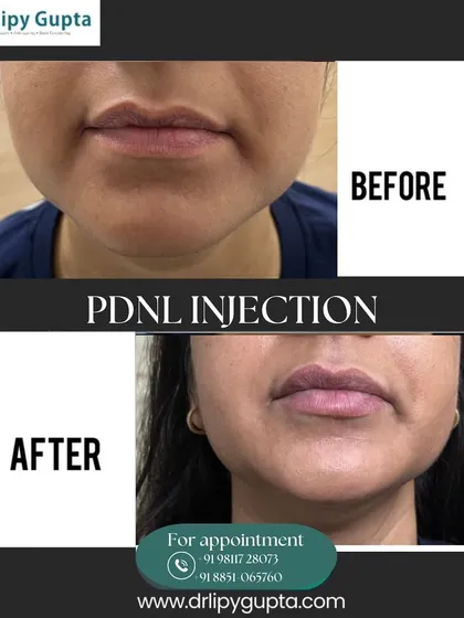This before and after shows the subtle but impactful result of a PDNL injection around the mouth. We've softened the lines and improved skin texture for a smoother, more youthful appearance.