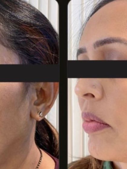 A fantastic result from the Korean Glass Skin treatment, showing a dramatic reduction in acne scars and pigmentation.