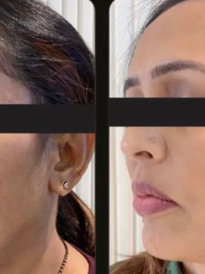 A fantastic result from the Korean Glass Skin treatment, showing a dramatic reduction in acne scars and pigmentation.