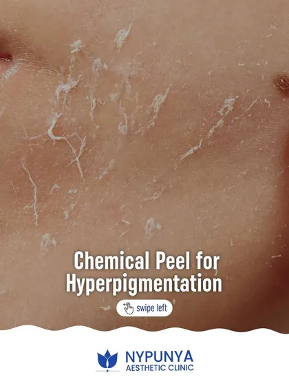 This close-up shot shows skin peeling after a chemical peel, a process that removes the damaged outer layers to treat hyperpigmentation.