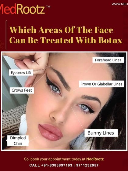 Botox is a precise tool for treating dynamic wrinkles caused by muscle movement. I commonly use it to address forehead lines, frown lines between the brows, and crow's feet, as well as for providing a subtle eyebrow lift.