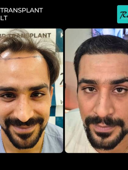 This before-and-after shot shows a significant improvement in the frontal hairline. The new hairline is designed to be age-appropriate and looks completely natural.