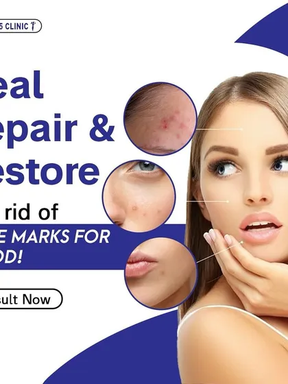 We focus on healing, repairing, and restoring your skin. This graphic illustrates how our treatments target and eliminate acne marks for good, helping you regain a smooth, clear complexion.