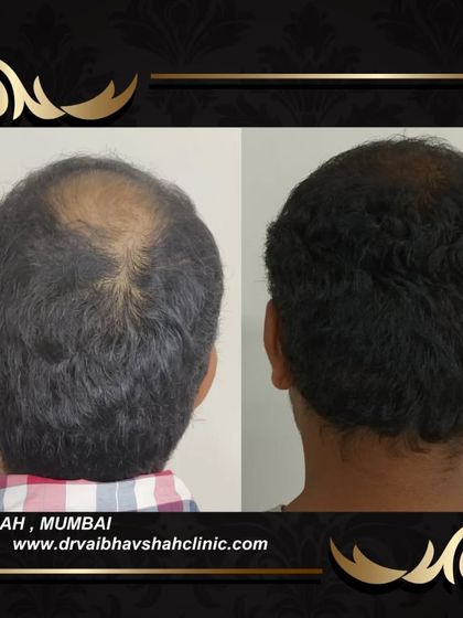 This back-of-the-head view shows a successful restoration of the crown. The hair growth is uniform and dense.