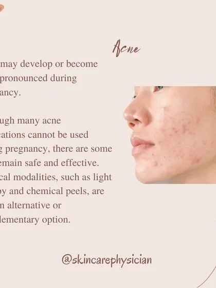 Acne is a very common skin change during pregnancy. The good news is that there are safe and effective medications and physical treatments, like light therapy and chemical peels, that we can use to manage it.