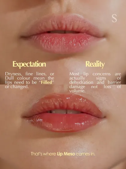 Many believe that dull or lined lips need fillers, but often the real issue is dehydration and barrier damage. This is where our Lip Meso ritual comes in. It is a targeted treatment designed to restore hydration and health from within for naturally soft, plump lips.