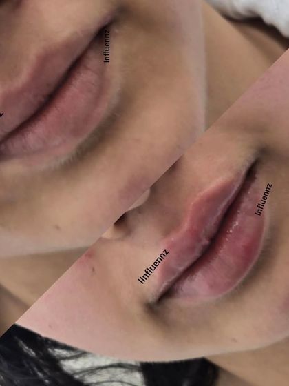 This split-screen view highlights the immediate enhancement from a lip filler treatment, adding shape and fullness for a naturally plumper look.