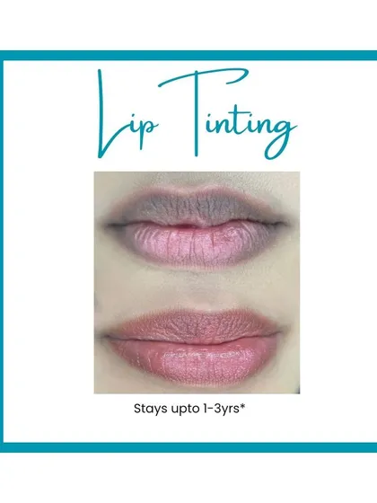 This image demonstrates a lip tinting procedure designed to address dark pigmentation. The treatment successfully neutralized the darker tones, resulting in a uniform, soft pink color across both lips for a refreshed and natural look.