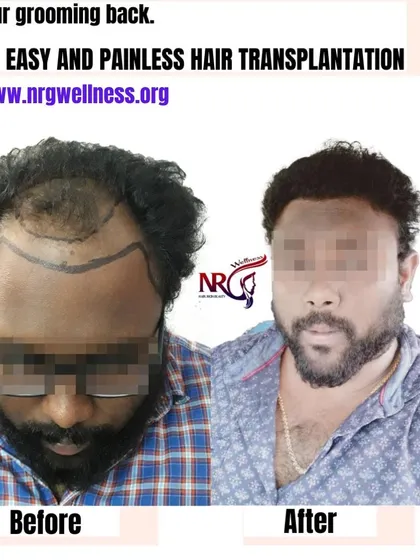 We help you get your grooming back with our painless hair transplantation process. This client regained not just his hair but also his style and confidence.