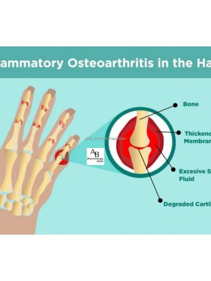This diagram shows what happens inside the hand during inflammatory osteoarthritis. It details how the cartilage degrades and synovial fluid builds up, leading to pain and stiffness in the finger joints.