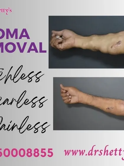 Here is a clear example of our stitchless and scarless lipoma removal. The 'before' shows multiple fatty lumps on the arm, and the 'after' shows the smooth result post-procedure, with no visible scarring.