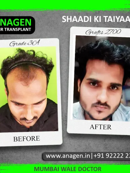"Shaadi Ki Taiyaari" (Wedding Preparation). This patient with Grade 3A baldness is now ready for his wedding after a 2700 graft transplant gave him a confident, new look.