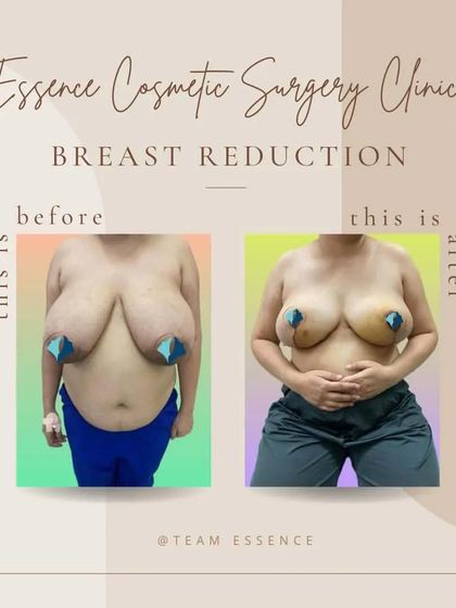 A straightforward before-and-after of a breast reduction surgery. The 'after' photo clearly shows a significant decrease in breast volume, resulting in a more proportionate and comfortable chest for the patient.