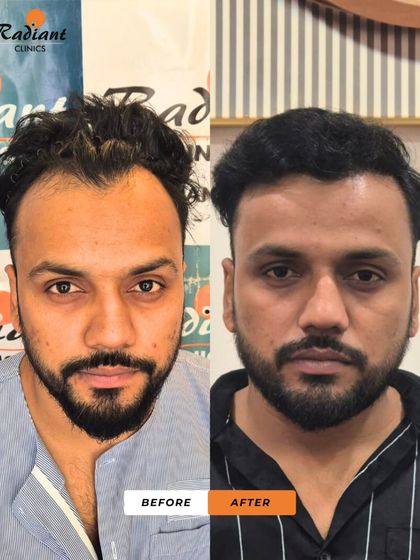 The frontal view of the patient in images 28 and 29. The new hairline and added density have completely changed his look, giving him a renewed sense of confidence.