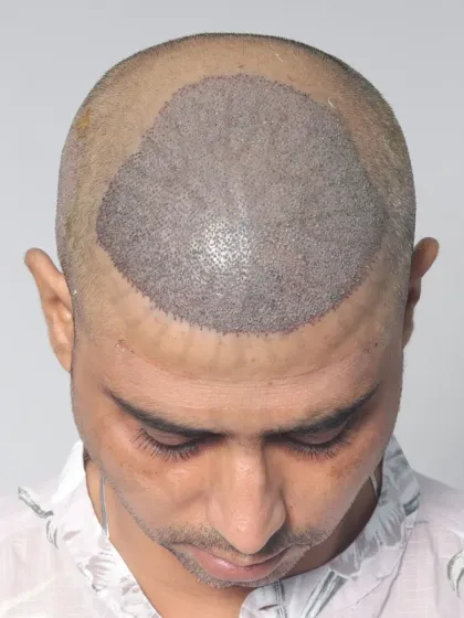 A 20-month transformation for a Diffuse Grade 5A patient. With 3800 grafts, we restored his hairline, frontal region, and mid-scalp for a lasting, natural look.