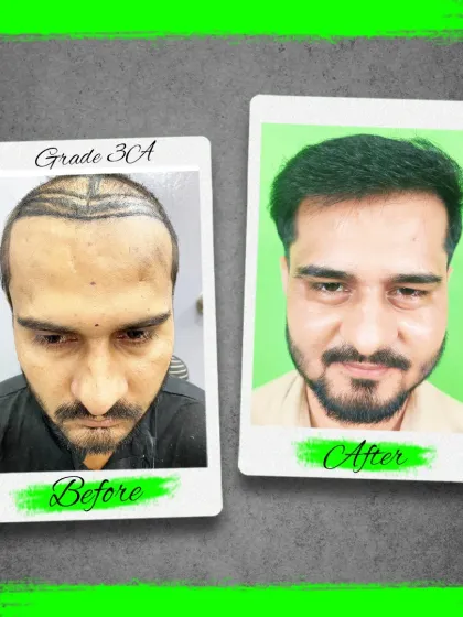 A fantastic before and after result for a patient with Grade 3A baldness. Our focus on natural hairline design and density delivers results that look completely authentic.