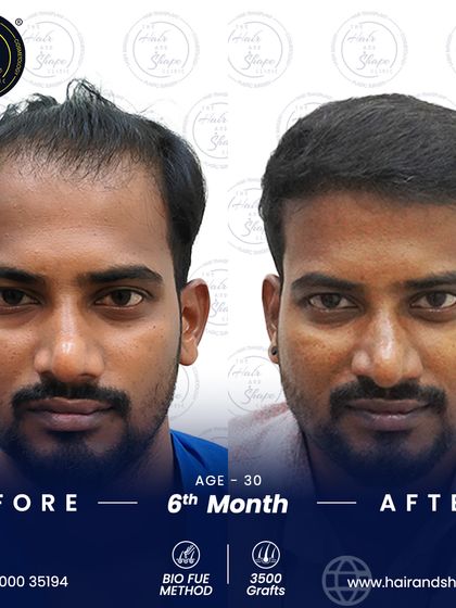 This 6-month progress after a 3500-graft BIO FUE transplant shows a remarkable change, restoring the patient's hairline and confidence.