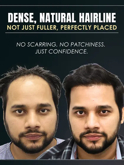The final result is a dense, natural hairline that is perfectly placed. There is no scarring or patchiness, just a confident new look.
