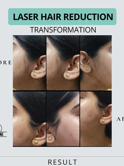 Unwanted facial hair can be a source of constant worry. This before and after collage shows the significant reduction of hair on the sideburns and cheeks, resulting in clearer, smoother skin and renewed confidence.