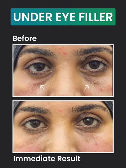 A frontal view showcasing the immediate results of an under-eye filler treatment. Notice how the hollowness beneath both eyes is visibly reduced, creating a smoother and more rested appearance right after the procedure.