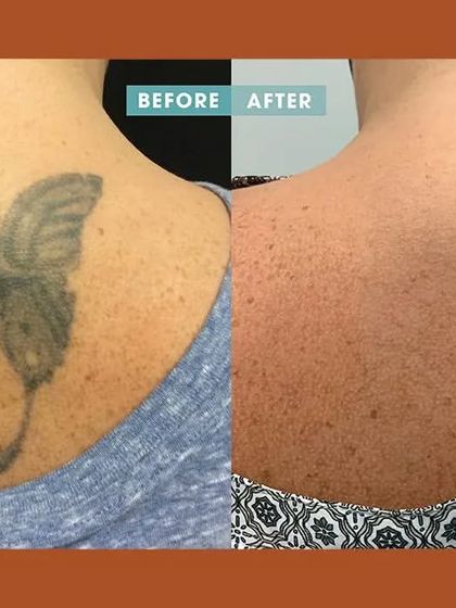 A powerful before-and-after image showcasing the complete removal of a large butterfly tattoo from a patient's back, demonstrating the effectiveness of our laser tattoo removal process.
